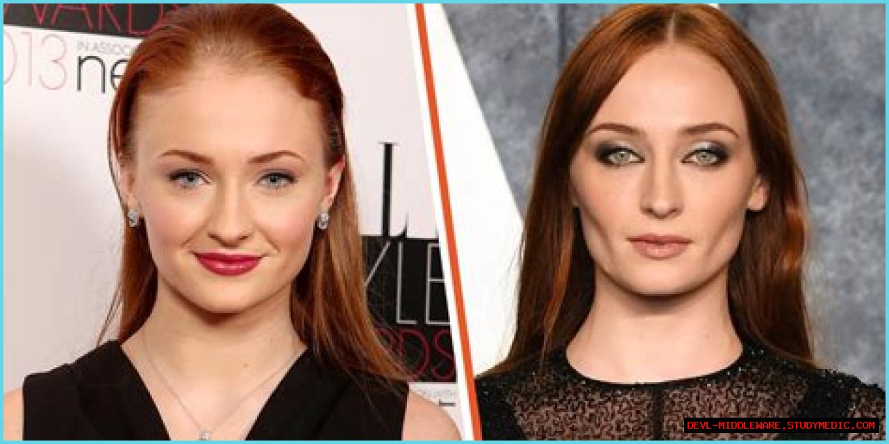 Unveiling The Transformation: Sophie Turner And Buccal Fat Removal